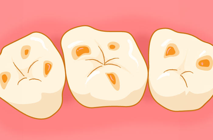 3月4日は「酸蝕歯の日」です! 3月4日は「酸蝕歯の日」です!